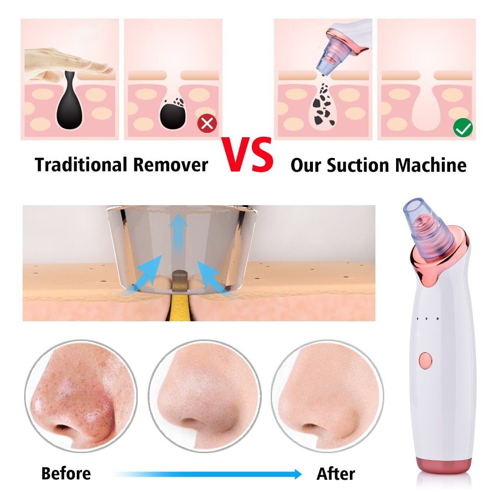 Blackhead Instrument Electric Suction Facial Washing Instrument Beauty Acne Cleaning Blackhead Suction Instrument - Urban Mart